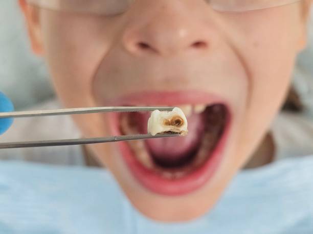 Best Dentist for Tooth Abscess  in Union City, PA